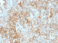 IHC testing of FFPE human renal cell carcinoma with CD147 antibody (clone 8D6).