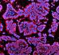 Immunofluorescent staining of ENTPD5 using anti-ENTPD5 antibody (red). ENTPD5 was detected in a paraffin-embedded section of human lung cancer tissue. Heat mediated antigen retrieval was performed in EDTA buffer (pH 8.0, epitope retrieval solution). The tissue section was blocked with 10% goat serum. The tissue section was then incubated with 5 ug/ml rabbit anti-ENTPD5 antibody overnight at 4oC. Cy3 Conjugated Goat Anti-Rabbit IgG was used as secondary antibody at 1:500 dilution and incubated for 30 minutes