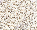 IHC staining of FFPE human renal clear cell carcinoma tissue with CCAR2 antibody. HIER: boil tissue sections in pH8 EDTA for 20 min and allow to cool before testing.