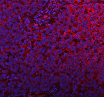 Immunofluorescent staining of FFPE human lung cancer tissue with PLBD2 antibody (red) and DAPI nuclear stain (blue). HIER: steam section in pH8 EDTA buffer for 20 min.