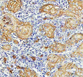 IHC analysis of LY6D using anti-LY6D antibody. LY6D was detected in a paraffin-embedded section of human skin cancer tissue. Heat mediated antigen retrieval was performed in EDTA buffer (pH 8.0, epitope retrieval solution). The tissue section was blocked with 10% goat serum. The tissue section was then incubated with 2 ug/ml rabbit anti-LY6D antibody overnight at 4oC. Peroxidase Conjugated Goat Anti-rabbit IgG was used as secondary antibody and incubated for 30 min at 37oC.