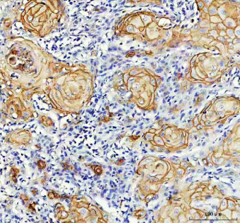 IHC analysis of LY6D using anti-LY6D antibody. LY6D was detected in a paraffin-embedded section of human skin cancer tissue. Heat mediated antigen retrieval was performed in EDTA buffer (pH 8.0, epitope retrieval solution). The tissue section was blocked with 10% goat serum. The tissue section was then incubated with 2 ug/ml rabbit anti-LY6D antibody overnight at 4oC. Peroxidase Conjugated Goat Anti-rabbit IgG was used as secondary antibody and incubated for 30 min at 37oC.