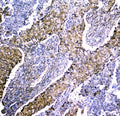 IHC staining of FFPE human lung cancer with LRTOMT antibody. HIER: boil tissue sections in pH6, 10mM citrate buffer, for 20 min and allow to cool before testing.