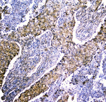 IHC staining of FFPE human lung cancer with LRTOMT antibody. HIER: boil tissue sections in pH6, 10mM citrate buffer, for 20 min and allow to cool before testing.