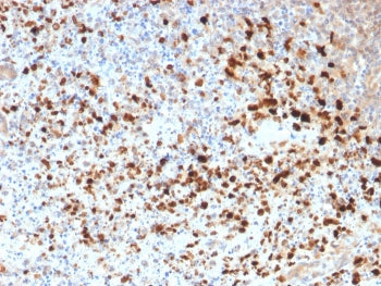 IHC staining of FFPE human cervix with HSV1 antibody. Required HIER: boil tissue sections in pH 9 10mM Tris with 1mM EDTA for 10-20 min followed by cooling at RT for 20 min.