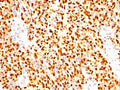 IHC: Formalin-fixed, paraffin-embedded human rhabdomyosarcoma stained with anti-Myogenin antibody (clone SPM144).