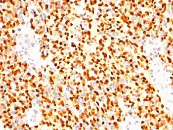 IHC: Formalin-fixed, paraffin-embedded human rhabdomyosarcoma stained with anti-Myogenin antibody (clone SPM144).