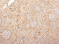 IHC staining of FFPE human prostate carcinoma with Fibronectin antibody (clone 616). HIER: boil tissue sections in 10mM Tris with 1mM EDTA, pH 9, for 10-20 min followed by cooling prior to testing.