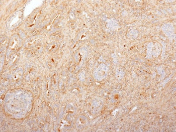 IHC staining of FFPE human prostate carcinoma with Fibronectin antibody (clone 616). HIER: boil tissue sections in 10mM Tris with 1mM EDTA, pH 9, for 10-20 min followed by cooling prior to testing.