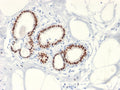 IHC testing of FFPE human breast cancer with Estrogen Receptor antibody (clone ESR1/2299R). Required HIER: boil tissue sections in 10mM citrate buffer, pH 6, for 10-20 min followed by cooling at RT for 20 min.