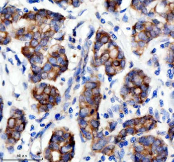 Immunohistochemical staining of SESN2 using anti-SESN2 antibody. SESN2 was detected in a paraffin-embedded section of human breast cancer tissue. Heat mediated antigen retrieval was performed in EDTA buffer (pH 8.0, epitope retrieval solution). The tissue section was blocked with 10% goat serum. The tissue section was then incubated with 2 ug/ml rabbit anti-SESN2 antibody overnight at 4oC. Peroxidase Conjugated Goat Anti-rabbit IgG was used as secondary antibody and incubated for 30 min at 37oC.