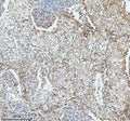 Immunohistochemical staining of SBK1 using anti-SBK1 antibody. SBK1 was detected in a paraffin-embedded section of human ovarian cancer tissue. Heat mediated antigen retrieval was performed in EDTA buffer (pH 8.0, epitope retrieval solution). The tissue section was blocked with 10% goat serum. The tissue section was then incubated with 2 ug/ml rabbit anti-SBK1 antibody overnight at 4oC. Peroxidase Conjugated Goat Anti-rabbit IgG was used as secondary antibody and incubated for 30 min at 37oC.