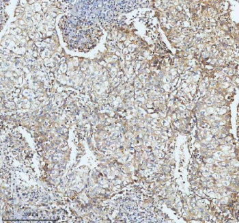 Immunohistochemical staining of SBK1 using anti-SBK1 antibody. SBK1 was detected in a paraffin-embedded section of human ovarian cancer tissue. Heat mediated antigen retrieval was performed in EDTA buffer (pH 8.0, epitope retrieval solution). The tissue section was blocked with 10% goat serum. The tissue section was then incubated with 2 ug/ml rabbit anti-SBK1 antibody overnight at 4oC. Peroxidase Conjugated Goat Anti-rabbit IgG was used as secondary antibody and incubated for 30 min at 37oC.