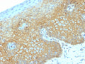 IHC testing of FFPE human cervical carcinoma with recombinant b-Catenin antibody (clone CTNNB1/2030R). Required HIER: boil tissue sections in 10mM citrate buffer, pH 6, for 10-20 min followed by cooling at RT for 20 min.