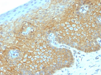 IHC testing of FFPE human cervical carcinoma with recombinant b-Catenin antibody (clone CTNNB1/2030R). Required HIER: boil tissue sections in 10mM citrate buffer, pH 6, for 10-20 min followed by cooling at RT for 20 min.