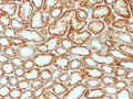 EPO Antibody Renal Cell Carcinoma IHC. Immunohistochemistry analysis of FFPE human renal cell carcinoma tissue using EPO Antibody demonstrates HRP-DAB brown cytoplasmic staining in tumor epithelial cells lining renal tubular structures, consistent with erythropoietin (EPO) expression as a hypoxia response hormone, while surrounding stromal elements show lower signal; nuclei are counterstained blue. HIER: boil tissue sections in pH 6 10 mM citrate buffer for 10-20 min followed by cooling at RT for 20 min.