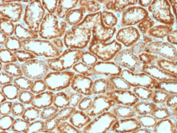 EPO Antibody Renal Cell Carcinoma IHC. Immunohistochemistry analysis of FFPE human renal cell carcinoma tissue using EPO Antibody demonstrates HRP-DAB brown cytoplasmic staining in tumor epithelial cells lining renal tubular structures, consistent with erythropoietin (EPO) expression as a hypoxia response hormone, while surrounding stromal elements show lower signal; nuclei are counterstained blue. HIER: boil tissue sections in pH 6 10 mM citrate buffer for 10-20 min followed by cooling at RT for 20 min.