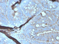 IHC staining of FFPE human colon carcinoma tissue with MERTK antibody (clone MERTK/3023). HIER: boil tissue sections in pH 9 10mM Tris with 1mM EDTA for 20 min and allow to cool before testing.