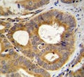TRPM8 antibody immunohsitochemistry analysis in formalin fixed and paraffin embedded human prostate carcinoma.