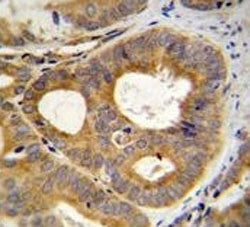 TRPM8 antibody immunohsitochemistry analysis in formalin fixed and paraffin embedded human prostate carcinoma.