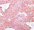 IHC testing of human small cell lung carcinoma stained with Chromogranin A antibody.