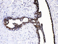 IHC testing of FFPE human breast cancer tissue with CASP8 antibody at 1ug/ml. HIER: steam section in pH6 citrate buffer for 20 min.