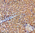 Immunohistochemical staining of TRIM59 using anti-TRIM59 antibody. TRIM59 was detected in a paraffin-embedded section of human liver cancer tissue. Heat mediated antigen retrieval was performed in EDTA buffer (pH 8.0, epitope retrieval solution). The tissue section was blocked with 10% goat serum. The tissue section was then incubated with 2 ug/ml rabbit anti-TRIM59 antibody overnight at 4oC. Peroxidase Conjugated Goat Anti-rabbit IgG was used as secondary antibody and incubated for 30 min at 37oC.