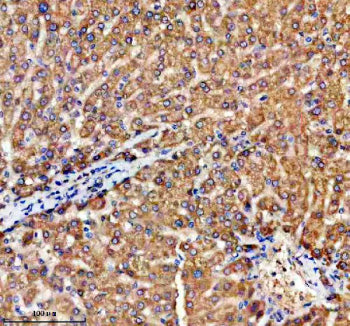 Immunohistochemical staining of TRIM59 using anti-TRIM59 antibody. TRIM59 was detected in a paraffin-embedded section of human liver cancer tissue. Heat mediated antigen retrieval was performed in EDTA buffer (pH 8.0, epitope retrieval solution). The tissue section was blocked with 10% goat serum. The tissue section was then incubated with 2 ug/ml rabbit anti-TRIM59 antibody overnight at 4oC. Peroxidase Conjugated Goat Anti-rabbit IgG was used as secondary antibody and incubated for 30 min at 37oC.