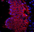 Immunofluorescent staining of human rectal cancer tissue with EpCAM antibody (red) and DAPI (blue). HIER: steam sections in pH6 citrate buffer for 20 min.