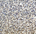 IHC staining of FFPE human melanoma tissue with SOX10 antibody. HIER: boil tissue sections in pH8 EDTA for 20 min and allow to cool before testing.