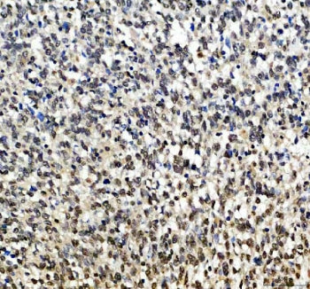 IHC staining of FFPE human melanoma tissue with SOX10 antibody. HIER: boil tissue sections in pH8 EDTA for 20 min and allow to cool before testing.