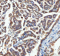 IHC staining of FFPE human lung adenocarcinoma tissue with AK1 antibody. HIER: boil tissue sections in pH8 EDTA for 20 min and allow to cool before testing.