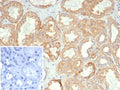 IHC staining of FFPE human kidney carcinoma tissue with HLA-G antibody (clone HLAG/7095). Inset: PBS used in place of primary Ab (secondary Ab negative control). HIER: boil tissue sections in pH 9 10mM Tris with 1mM EDTA for 20 min and allow to cool before testing.