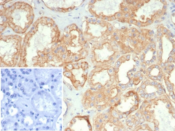 IHC staining of FFPE human kidney carcinoma tissue with HLA-G antibody (clone HLAG/7095). Inset: PBS used in place of primary Ab (secondary Ab negative control). HIER: boil tissue sections in pH 9 10mM Tris with 1mM EDTA for 20 min and allow to cool before testing.