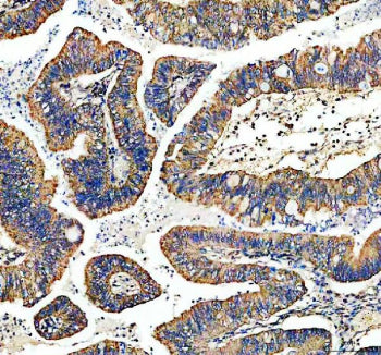 Immunohistochemical staining of TYRO3 using anti-TYRO3 antibody. TYRO3 was detected in a paraffin-embedded section of human stomach cancer tissue. Heat mediated antigen retrieval was performed in EDTA buffer (pH 8.0, epitope retrieval solution). The tissue section was blocked with 10% goat serum. The tissue section was then incubated with 2 ug/ml rabbit anti-TYRO3 antibody overnight at 4oC. Peroxidase Conjugated Goat Anti-rabbit IgG was used as secondary antibody and incubated for 30 min at 37oC.