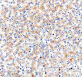 Immunohistochemical staining of NSUN6 using anti-NSUN6 antibody. NSUN6 was detected in a paraffin-embedded section of human liver cancer tissue. Heat mediated antigen retrieval was performed in EDTA buffer (pH 8.0, epitope retrieval solution). The tissue section was blocked with 10% goat serum. The tissue section was then incubated with 2 ug/ml rabbit anti-NSUN6 antibody overnight at 4oC. Peroxidase Conjugated Goat Anti-rabbit IgG was used as secondary antibody and incubated for 30 min at 37oC.