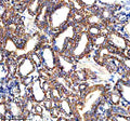 Immunohistochemical staining of PARP16 using anti-PARP16 antibody. PARP16 was detected in a paraffin-embedded section of human thyroid cancer tissue. Heat mediated antigen retrieval was performed in EDTA buffer (pH 8.0, epitope retrieval solution). The tissue section was blocked with 10% goat serum. The tissue section was then incubated with 2 ug/ml rabbit anti-PARP16 antibody overnight at 4oC. Peroxidase Conjugated Goat Anti-rabbit IgG was used as secondary antibody and incubated for 30 min at 37oC.