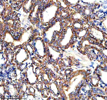 Immunohistochemical staining of PARP16 using anti-PARP16 antibody. PARP16 was detected in a paraffin-embedded section of human thyroid cancer tissue. Heat mediated antigen retrieval was performed in EDTA buffer (pH 8.0, epitope retrieval solution). The tissue section was blocked with 10% goat serum. The tissue section was then incubated with 2 ug/ml rabbit anti-PARP16 antibody overnight at 4oC. Peroxidase Conjugated Goat Anti-rabbit IgG was used as secondary antibody and incubated for 30 min at 37oC.