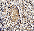 IHC staining of FFPE human testicular cancer tissue with PIK3R1 antibody. HIER: boil tissue sections in pH8 EDTA for 20 min and allow to cool before testing.