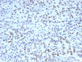 IHC staining of FFPE human Lynch disease colon with MutS homolog 2 antibody (clone MSH2/3165). HIER: boil tissue sections in pH 9 10mM Tris with 1mM EDTA for 20 min and allow to cool before testing.