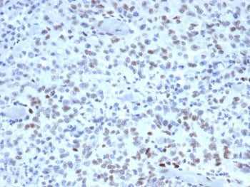 IHC staining of FFPE human Lynch disease colon with MutS homolog 2 antibody (clone MSH2/3165). HIER: boil tissue sections in pH 9 10mM Tris with 1mM EDTA for 20 min and allow to cool before testing.