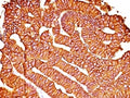 IHC: Formalin-fixed, paraffin-embedded human colon carcinoma stained with EpCAM antibody (SPM528).