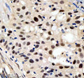 Immunohistochemical staining of SIN3B using anti-SIN3B antibody. SIN3B was detected in a paraffin-embedded section of human bladder cancer tissue. Heat mediated antigen retrieval was performed in EDTA buffer (pH 8.0, epitope retrieval solution). The tissue section was blocked with 10% goat serum. The tissue section was then incubated with 2 ug/ml rabbit anti-SIN3B antibody overnight at 4oC. Peroxidase Conjugated Goat Anti-rabbit IgG was used as secondary antibody and incubated for 30 min at 37oC.