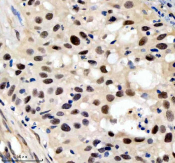 Immunohistochemical staining of SIN3B using anti-SIN3B antibody. SIN3B was detected in a paraffin-embedded section of human bladder cancer tissue. Heat mediated antigen retrieval was performed in EDTA buffer (pH 8.0, epitope retrieval solution). The tissue section was blocked with 10% goat serum. The tissue section was then incubated with 2 ug/ml rabbit anti-SIN3B antibody overnight at 4oC. Peroxidase Conjugated Goat Anti-rabbit IgG was used as secondary antibody and incubated for 30 min at 37oC.