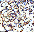 Immunohistochemical staining of TCTN1 using anti-TCTN1 antibody. TCTN1 was detected in a paraffin-embedded section of human thyroid cancer tissue. Heat mediated antigen retrieval was performed in EDTA buffer (pH 8.0, epitope retrieval solution). The tissue section was blocked with 10% goat serum. The tissue section was then incubated with 2 ug/ml rabbit anti-TCTN1 antibody overnight at 4oC. Peroxidase Conjugated Goat Anti-rabbit IgG was used as secondary antibody and incubated for 30 min at 37oC.