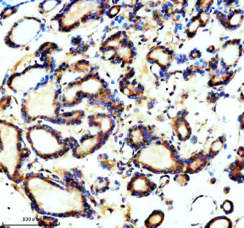 Immunohistochemical staining of TCTN1 using anti-TCTN1 antibody. TCTN1 was detected in a paraffin-embedded section of human thyroid cancer tissue. Heat mediated antigen retrieval was performed in EDTA buffer (pH 8.0, epitope retrieval solution). The tissue section was blocked with 10% goat serum. The tissue section was then incubated with 2 ug/ml rabbit anti-TCTN1 antibody overnight at 4oC. Peroxidase Conjugated Goat Anti-rabbit IgG was used as secondary antibody and incubated for 30 min at 37oC.