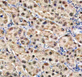 Immunohistochemical staining of TKFC using anti-TKFC antibody. TKFC was detected in a paraffin-embedded section of human pancreas cancer tissue. Heat mediated antigen retrieval was performed in EDTA buffer (pH 8.0, epitope retrieval solution). The tissue section was blocked with 10% goat serum. The tissue section was then incubated with 2 ug/ml rabbit anti-TKFC antibody overnight at 4oC. Peroxidase Conjugated Goat Anti-rabbit IgG was used as secondary antibody and incubated for 30 min at 37oC.