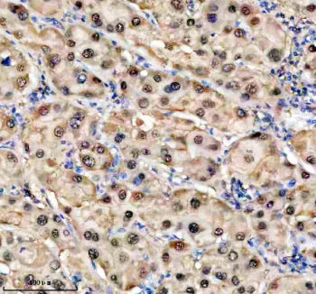 Immunohistochemical staining of TKFC using anti-TKFC antibody. TKFC was detected in a paraffin-embedded section of human pancreas cancer tissue. Heat mediated antigen retrieval was performed in EDTA buffer (pH 8.0, epitope retrieval solution). The tissue section was blocked with 10% goat serum. The tissue section was then incubated with 2 ug/ml rabbit anti-TKFC antibody overnight at 4oC. Peroxidase Conjugated Goat Anti-rabbit IgG was used as secondary antibody and incubated for 30 min at 37oC.
