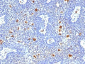 IHC testing of FFPE human cervix with HPV-16 E6 antibody (clone HPV16/1296). Required HIER: boil tissue sections in pH 9 10mM Tris with 1mM EDTA for 10-20 min followed by cooling at RT for 20 min.