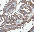 IHC analysis of CAMKK2 using anti-CAMKK2 antibody. CAMKK2 was detected in a paraffin-embedded section of human esophageal squamous carcinoma tissue. Heat mediated antigen retrieval was performed in EDTA buffer (pH 8.0, epitope retrieval solution). The tissue section was blocked with 10% goat serum. The tissue section was then incubated with 2 ug/ml rabbit anti-CAMKK2 antibody overnight at 4oC. Peroxidase Conjugated Goat Anti-rabbit IgG was used as secondary antibody and incubated for 30 min at 37oC.